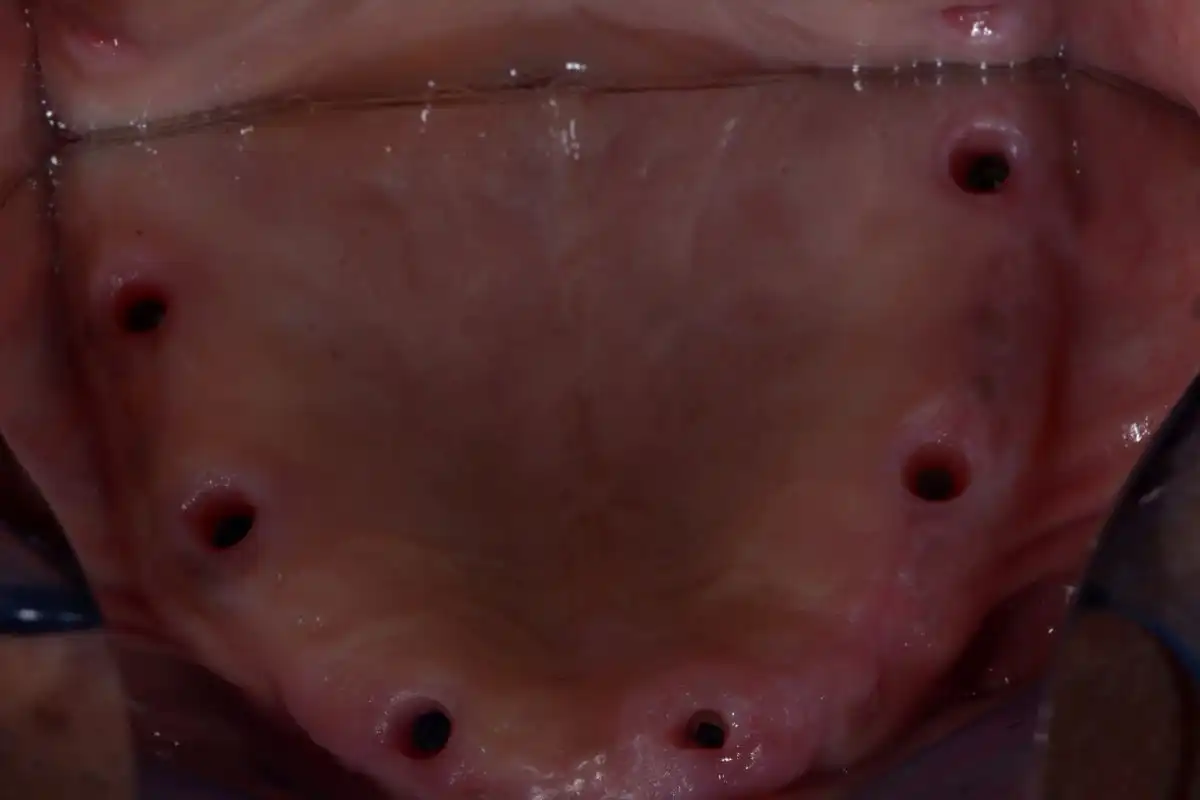 All-on-6 Tunisie — photo initiale avant traitement Implant Dentaire Tunisie